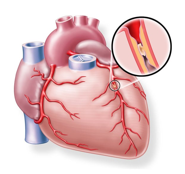 herzinfarkt-infoabend-würzburg-2025